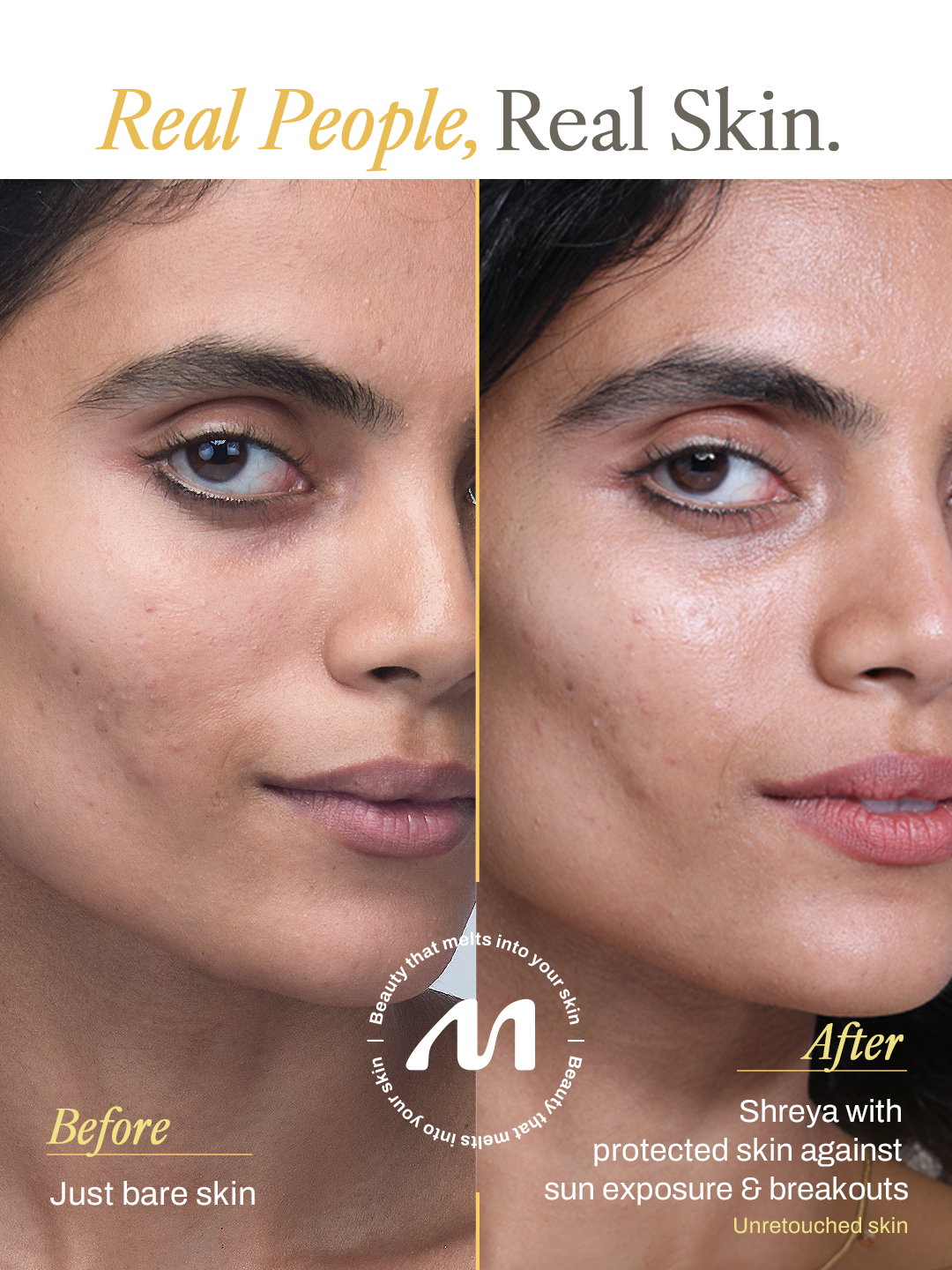 Anti Acne Sunscreen