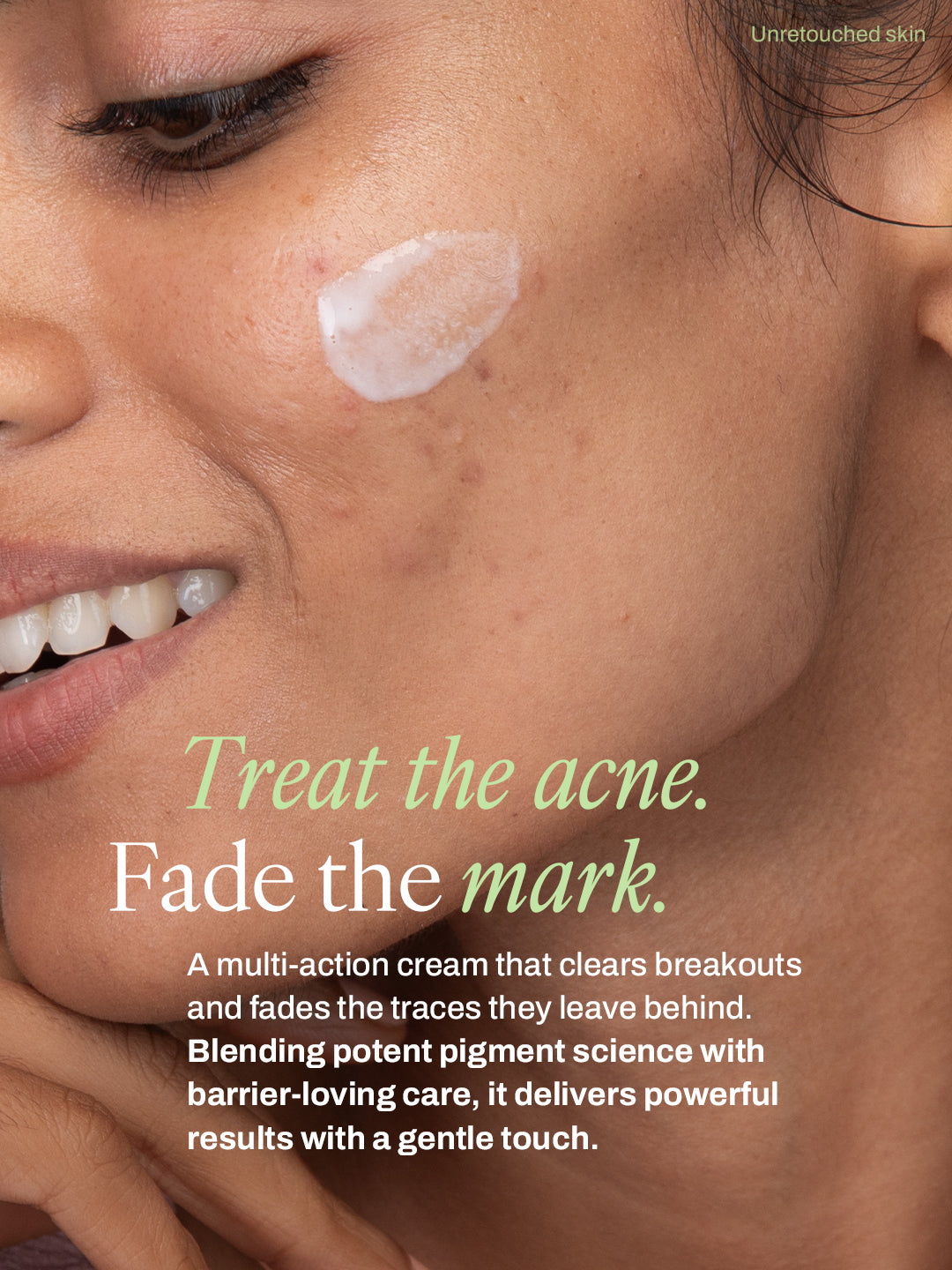 Fade Fix Acne Cream